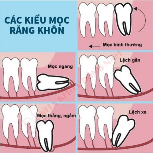 Kinh nghiệm nhổ răng khôn sống nhật Kinh nghiệm nhổ răng khôn sống nhật